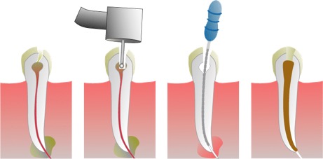 Root Canal