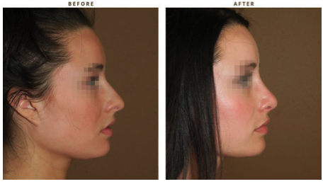 What Should You Expect from a Rhinoplasty Job?